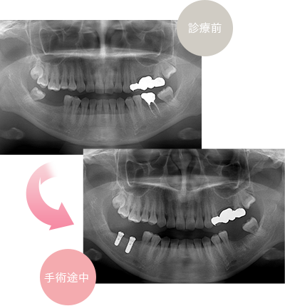 インプラント治療