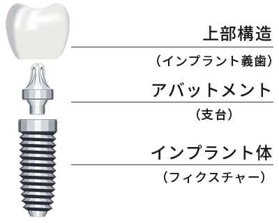 インプラント治療