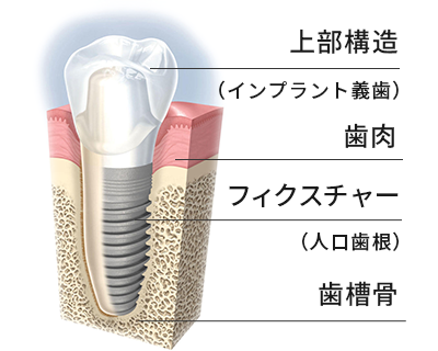 インプラント治療