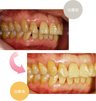 アライナー矯正