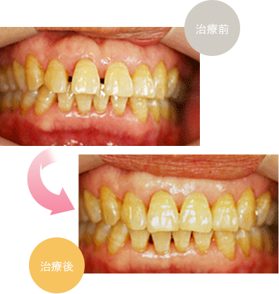 アライナー矯正