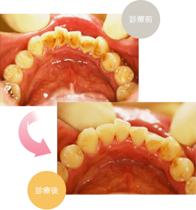 歯周病とは？